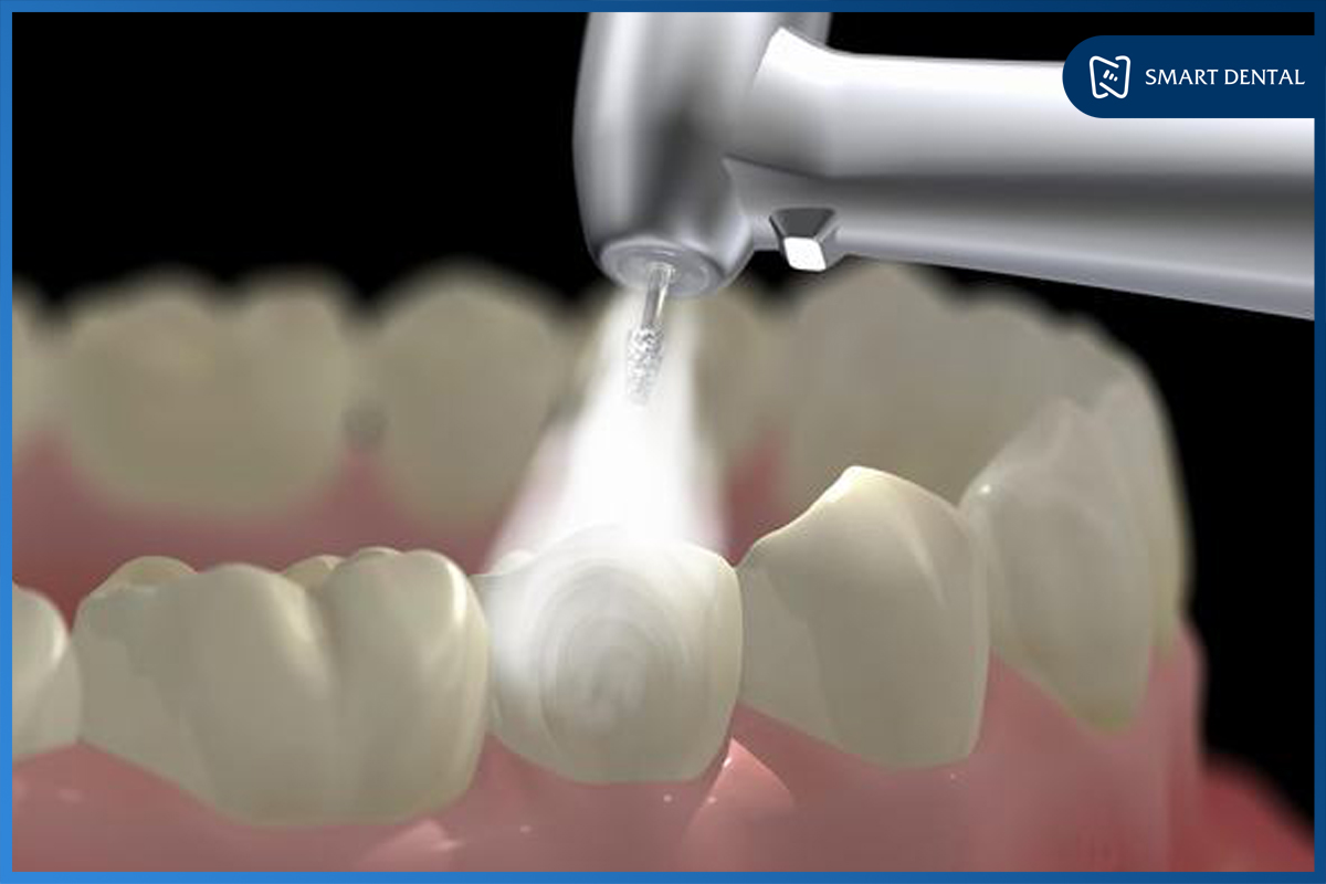 Lấy cao răng có đau không 2 Lấy cao răng có đau không 2
