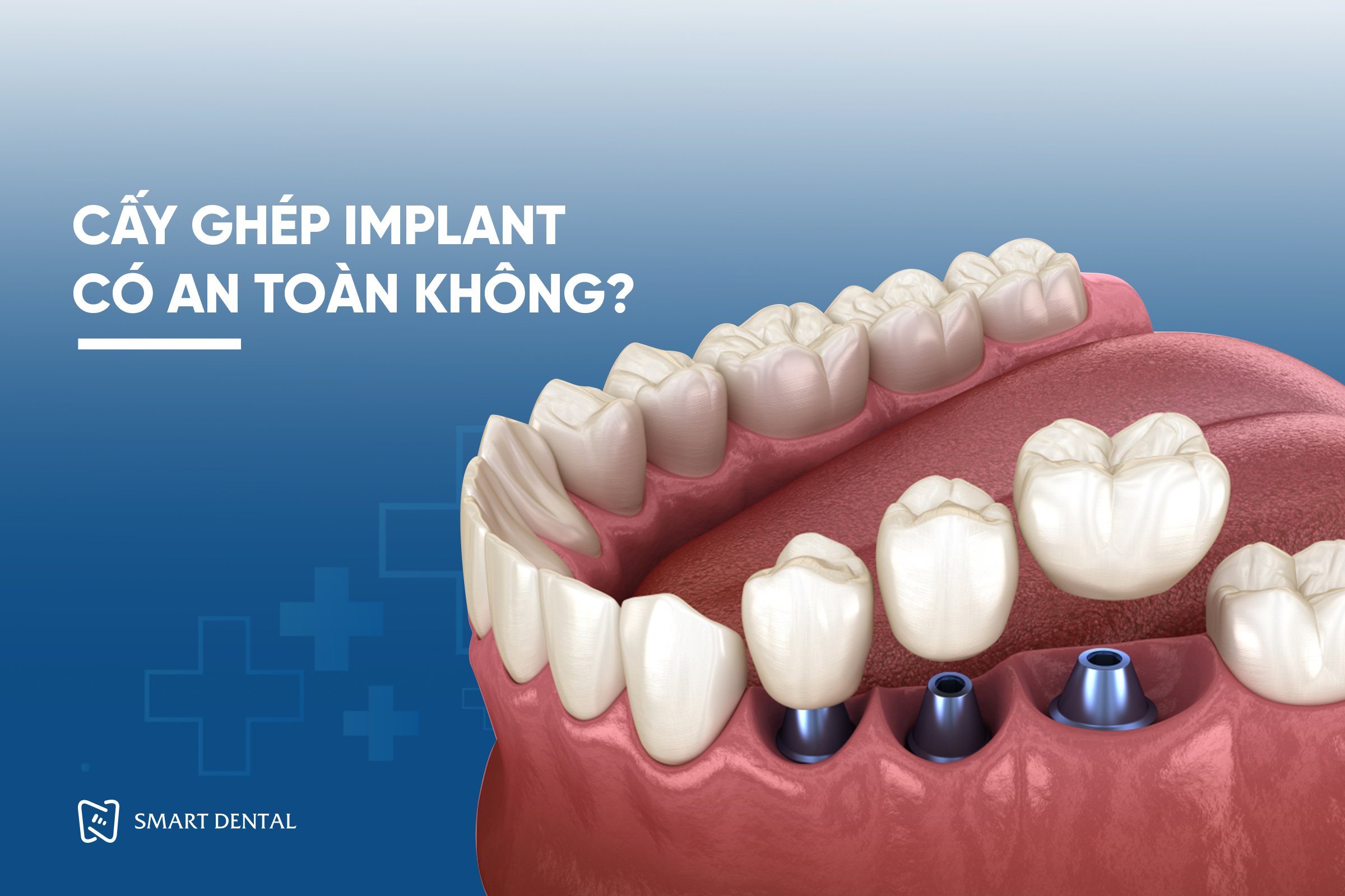 Cấy ghép Implant có an toàn không 3 Cấy ghép Implant có an toàn không 3