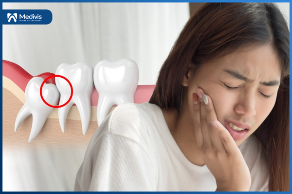 Răng khôn mọc ngầm là gì? Cách giải quyết răng mọc ngầm TRIỆT ĐỂ! 3