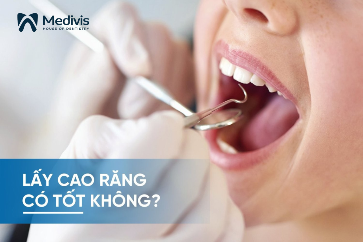Lấy cao răng có tốt không 1