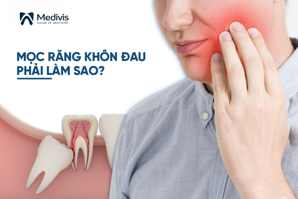 Mọc răng khôn đau 3