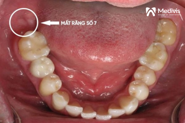 Trồng răng số 7 1