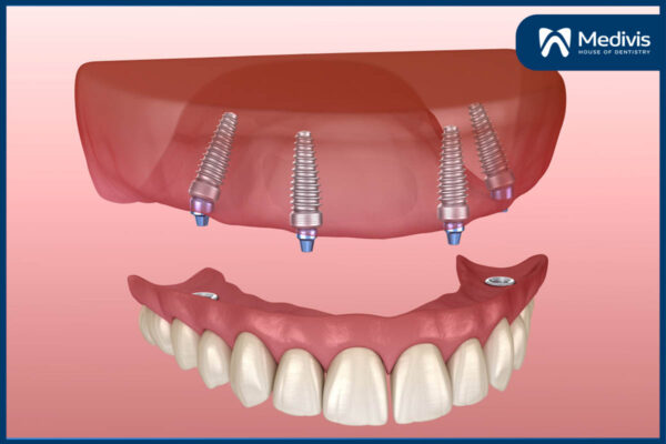 CẤY GHÉP implant all on 4 1