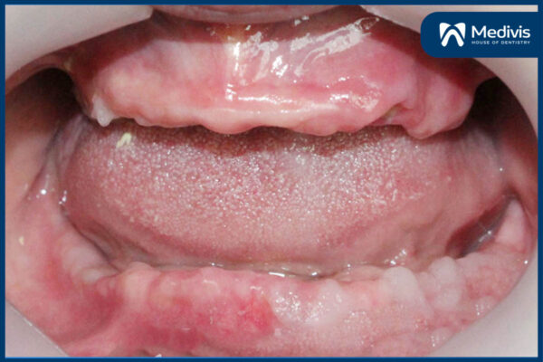 CẤY GHÉP implant all on 4 2