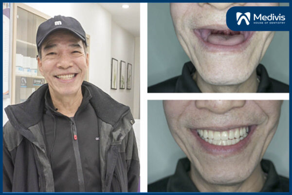 CẤY GHÉP implant all on 4 5