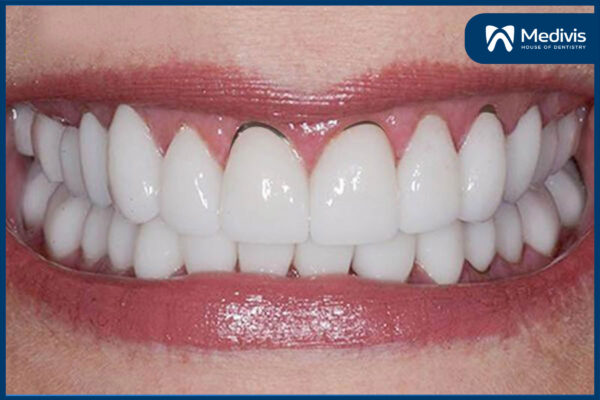 Trồng răng sứ có tháo ra được không 2