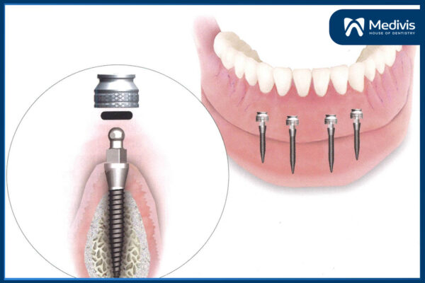 Cấy ghép mini Implant 1