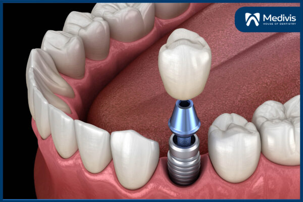 Trồng răng Implant có đau không 1