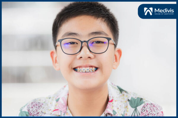Niềng răng thưa mất bao lâu 2
