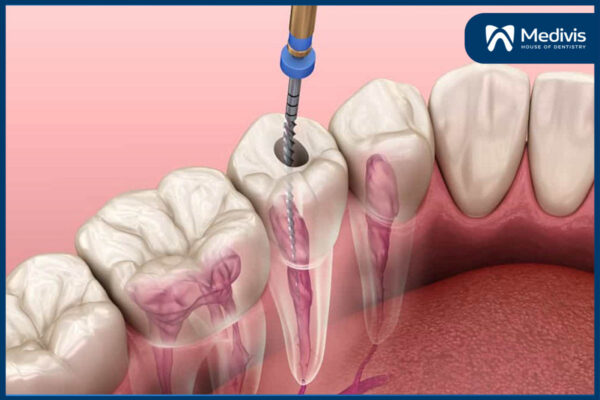 Điều trị tủy răng 1