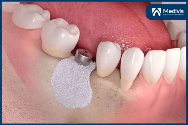 Trồng răng Implant Implant mất bao lâu 4