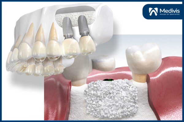 Trồng răng Implant Implant mất bao lâu 5