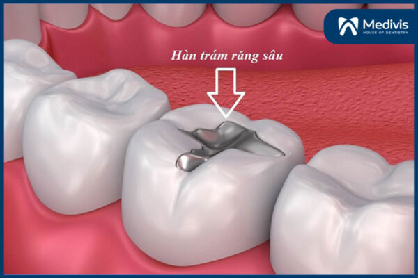 Hàn trám răng 1