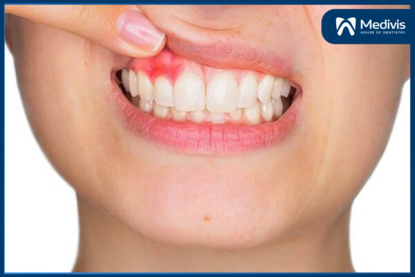 Hôi miệng làm sao hết? BẬT MÍ 5 mẹo dân gian giúp hơi thở thơm tho 1