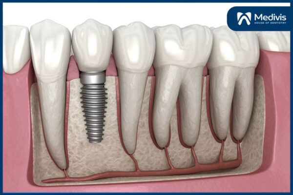 kinh nghiệm trồng răng implant 1