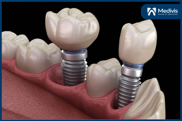 Công nghệ trồng răng Implant 1