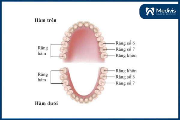 Mất răng hàm 1