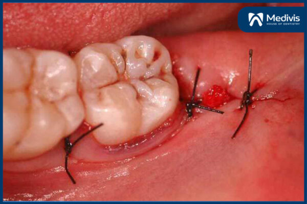 Những lưu ý khi nhổ răng số 8 1