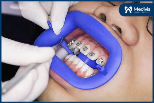 tác dụng của niềng răng 5