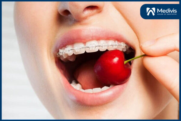 Niềng răng thưa mất bao lâu 3