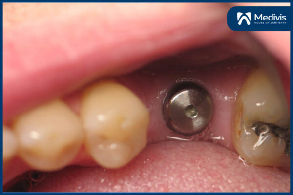 Phục hình răng sứ trên implant 2