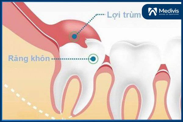 Răng khôn là răng số mấy 5