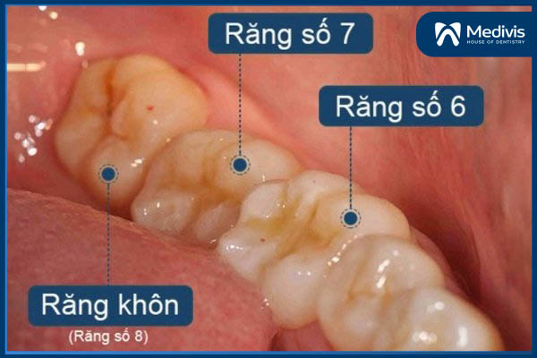 Răng khôn mọc thẳng 2