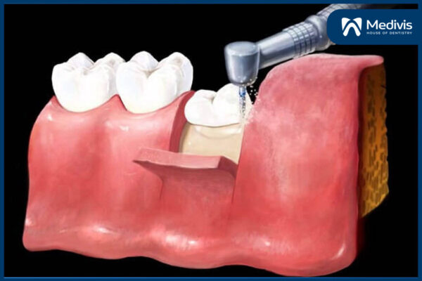 Răng khôn mọc lệch ra má 6