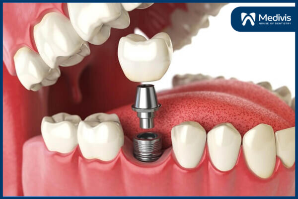 Trồng răng Implant bị sưng có sao không? - 5 cách giảm sưng hiệu quả 8