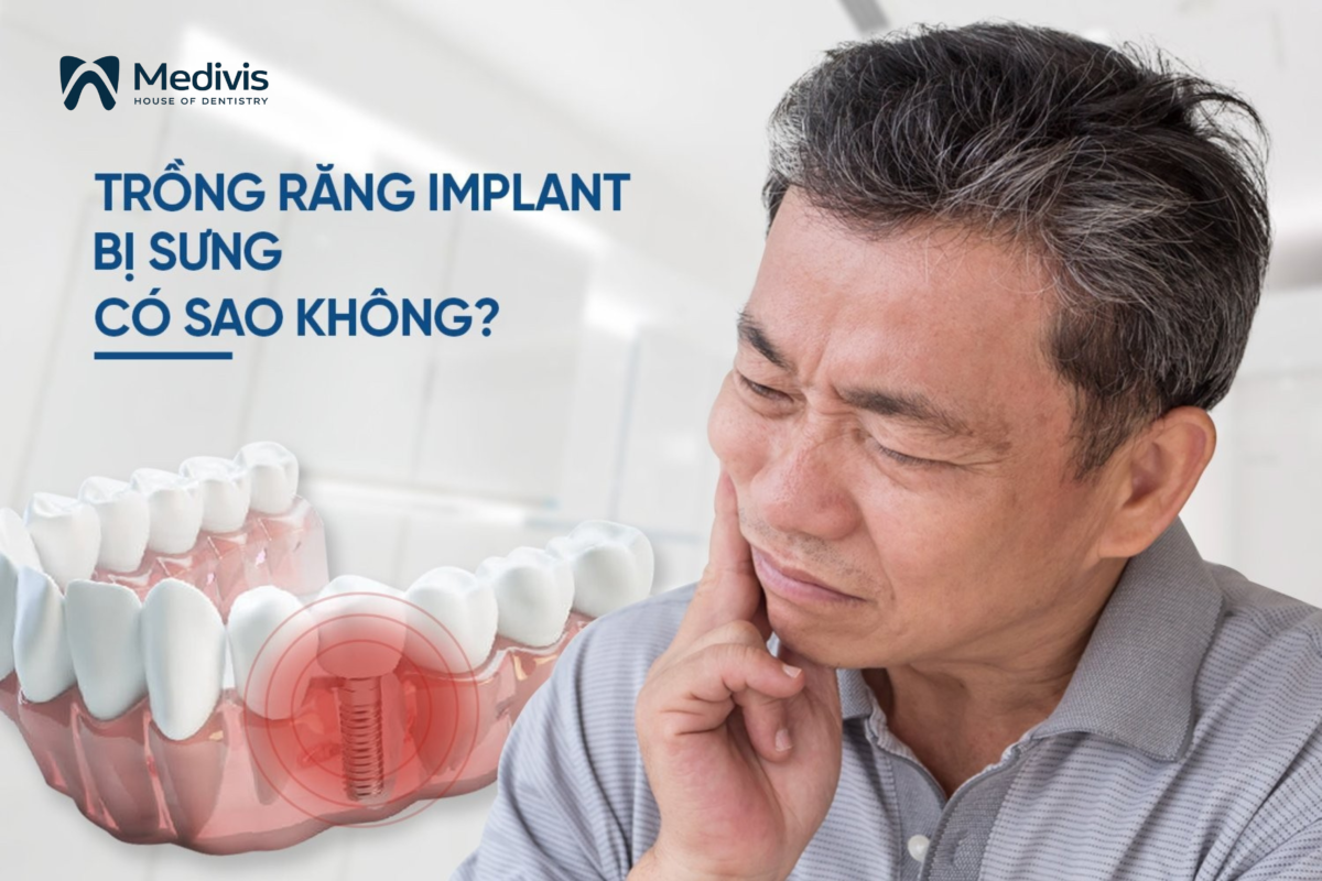 Trồng răng Implant bị sưng có sao không? - 5 cách giảm sưng hiệu quả 3