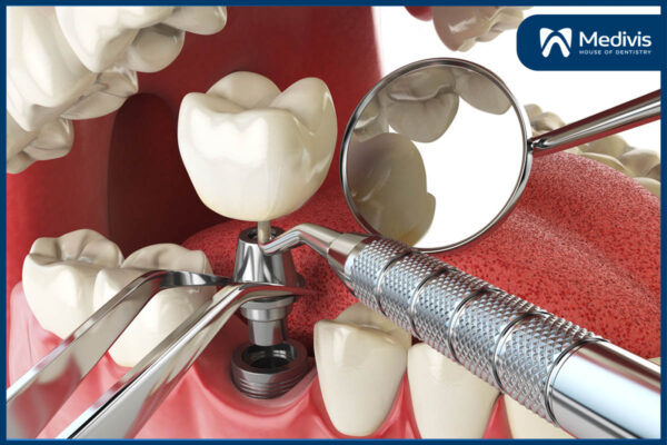 Trồng răng Implant có nguy hiểm không 1