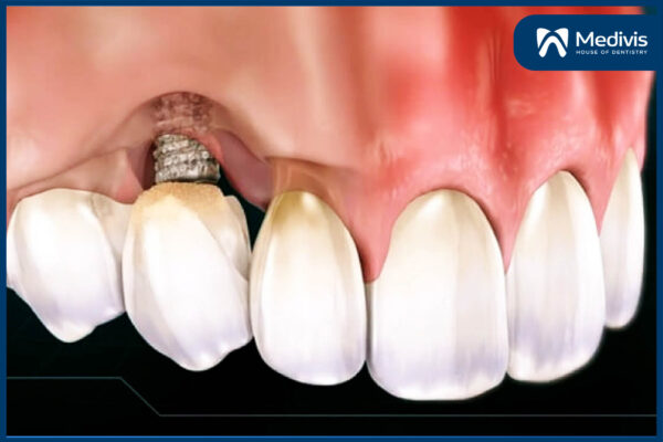 Trồng răng sứ có tháo ra được không 3