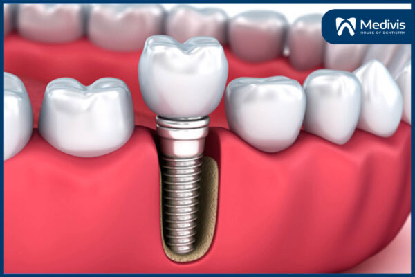 trồng răng implant tại Hà Nội 1