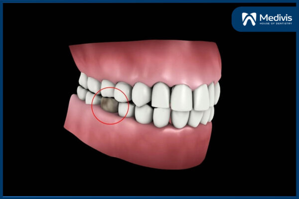 Trồng răng số 5 2