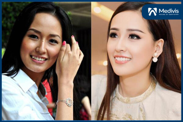 Niềng răng đẹp cỡ nào 6