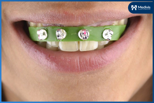 Niềng Răng Tại Nhà - Những hậu quả đáng “báo động” nên cẩn trọng 2
