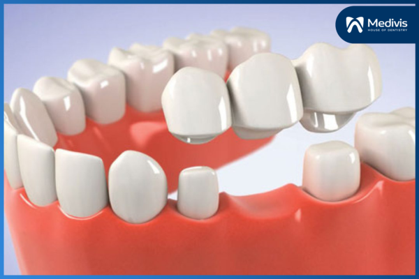 Trồng răng vĩnh viễn bằng phương pháp nào an toàn & hiệu quả? 2