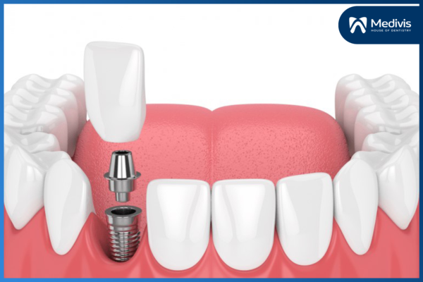 Trồng răng vĩnh viễn bằng phương pháp nào an toàn & hiệu quả? 3