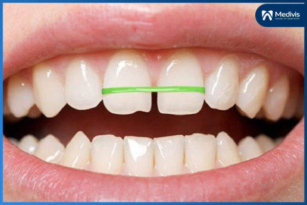 Niềng Răng Tại Nhà - Những hậu quả đáng “báo động” nên cẩn trọng 1