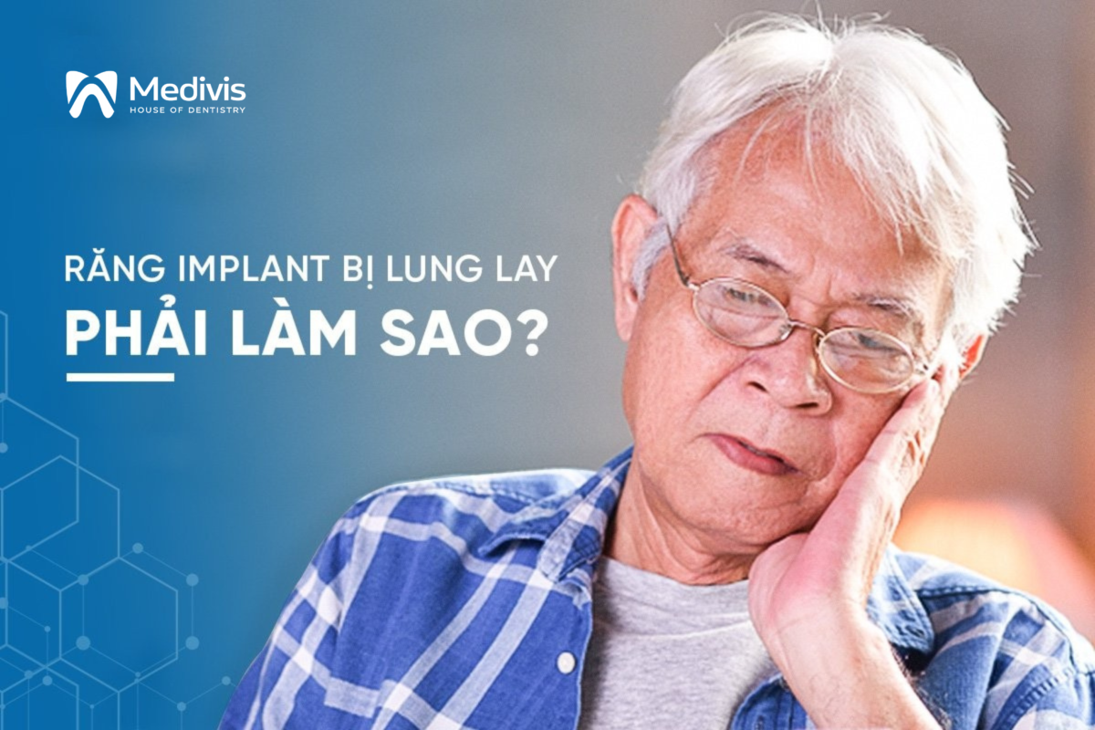 Răng Implant bị lung lay phải làm sao? Cách khắc phục nào hiệu quả? 1
