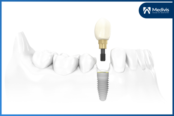 Răng Implant bị lung lay phải làm sao? Cách khắc phục nào hiệu quả? 2