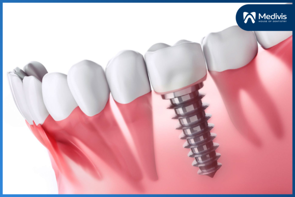 Trồng răng vĩnh viễn bằng phương pháp nào an toàn & hiệu quả? 4