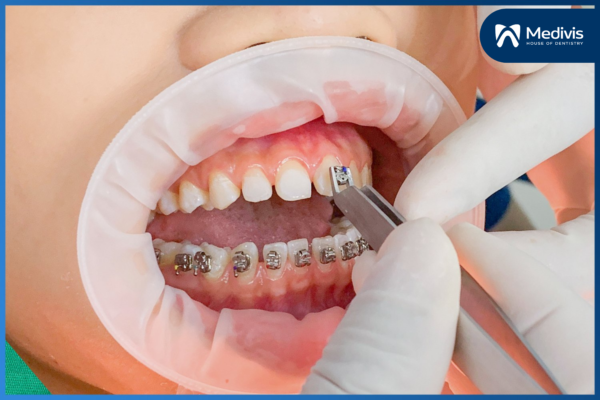 Niềng răng cửa - Giải pháp TỐI ƯU cho hàm răng đều đẹp & hài hòa 6