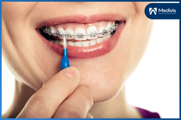 Chia sẻ “kinh nghiệm niềng răng” để đạt hiệu quả chỉnh nha tốt nhất 5