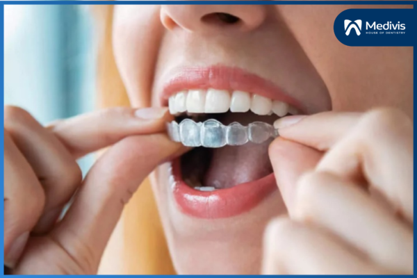 Niềng răng cửa - Giải pháp TỐI ƯU cho hàm răng đều đẹp & hài hòa 4