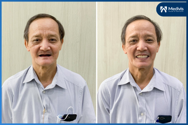 trồng lại răng bị mất 3