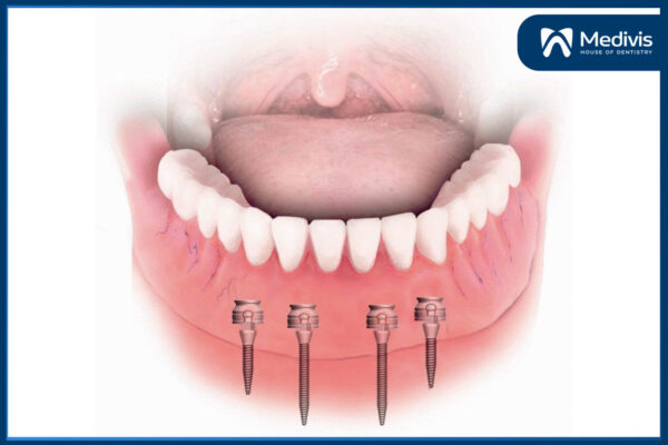 Cấy ghép mini Implant 3