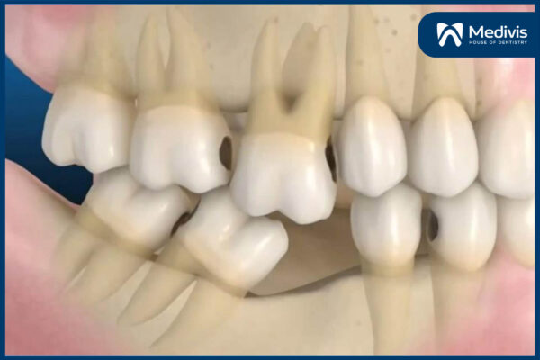 Mất răng hàm 5