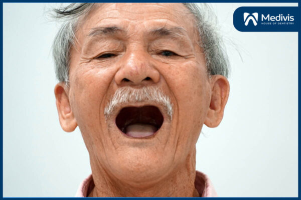 Trồng răng bằng phương pháp nào tốt nhất? Implant hay cầu răng? 2