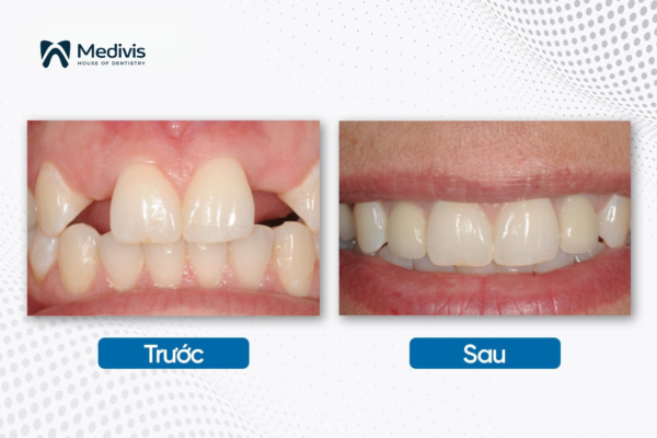 Trụ Implant Osstem 5